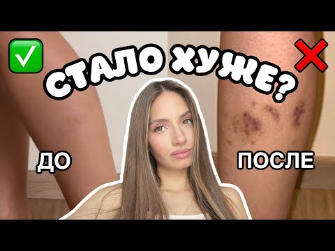 Видео: УДАЛЕНИЕ СОСУДОВ | ВАРИКОЗ: что важно знать, мой опыт, результат