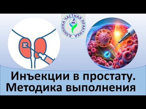 Видео: Инъекции в простату.  Методика выполнения