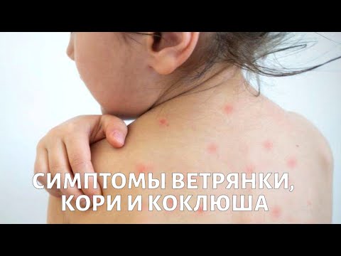 Видео: Симптомы ветрянки, кори и коклюша