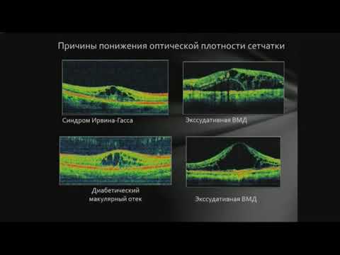 Видео: Оптическая когерентная томография (ОКТ)