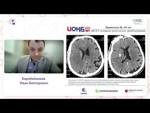 Видео: Тромболитическая терапия и тромбэктомия с ургентным стентированием. к.м.н. Коробейников И.В.