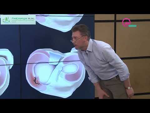 Видео: РАЗРЫВ МЕНИСКА - ВИДЫ разрыва мениска, на ТВ от хирурга травматолога-ортопеда Н.Н.Гнелицы