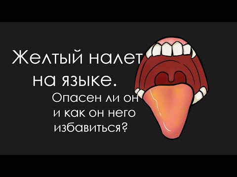 Видео: Важно! Желтый налет на языке!