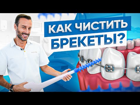 Видео: Как чистить зубы с брекетами? Разбираемся на реальном примере