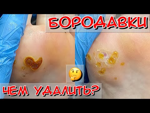 Видео: Чем удалять бородавки? / бородавки на стопе / заключительный визит