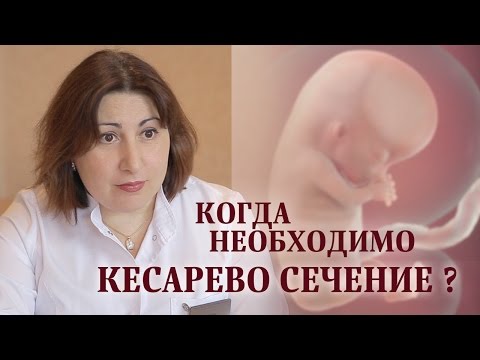 Видео: Когда кесарево сечение неизбежно?