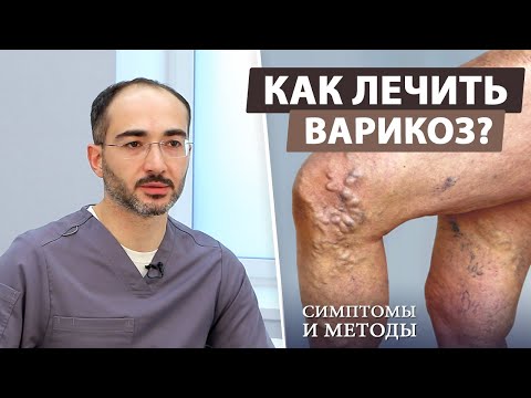 Видео: Современные методы лечения варикозного расширения вен (варикоз)