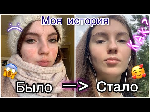 Видео: ИСЦЕЛИТЬ КОЖУ СИЛОЙ МЫСЛИ? Моя история.