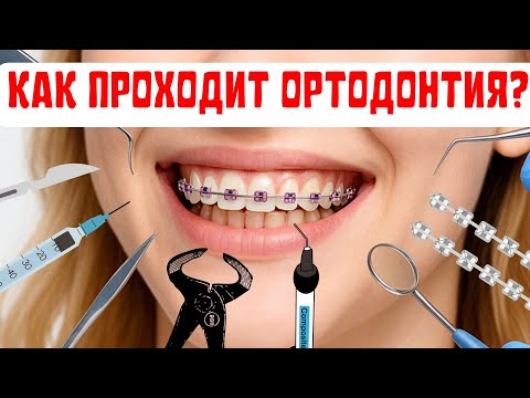 Видео: Брекеты: 6 этапов ортодонтического лечения