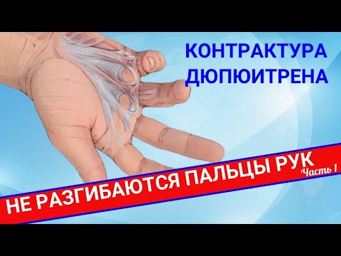 Видео: НЕ РАЗГИБАЮТСЯ ПАЛЬЦЫ: Контрактура Дюпюитрена (Часть 1)