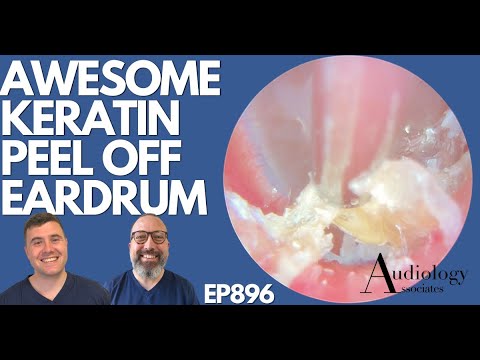 Видео: УДИВИТЕЛЬНЫЙ КЕРАТИНОВЫЙ ОТШЕЛУШИВАТЕЛЬ ДЛЯ БАРАБАННОЙ ПЕРЕПОНКИ - EP896