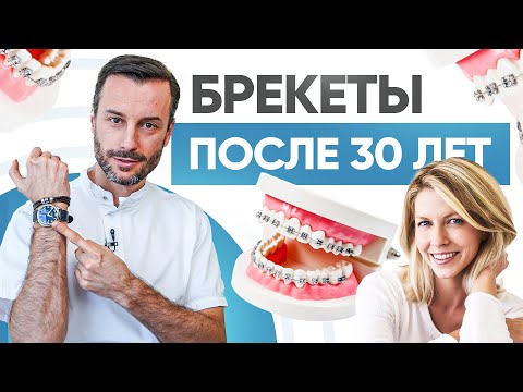 Видео: Брекеты после 30 лет. Когда уже поздно ставить брекеты?