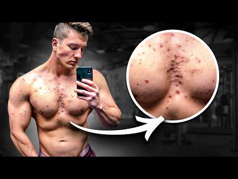 Видео: Откуда у Химиков и Натуралов Прыщи?