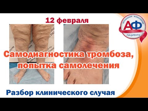 Видео: Самодиагностика тромбоза, попытка самолечения