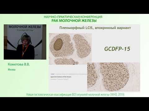 Видео: Неинвазивный дольковый рак молочной железы (LCIS)