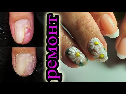 Видео: ❤ ГИПОАЛЛЕРГЕННЫЙ гель для ТРАВМИРОВАННЫХ ногтей ❤ IMPULS ❤ РОМАШКИ на ногтях ❤ РИСУЕМ ФРЕНЧ ❤
