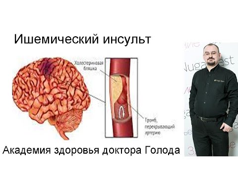 Видео: Ишемический инсульт – его виды, проявления и лечение.