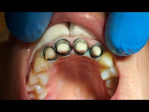 Видео: Лечение периодонтита восстановление вкладками циркониевыми коронками клинический кейс вторичное эндо