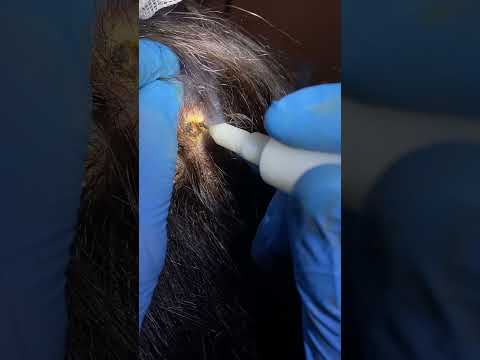 Видео: Удаление атеромы кожи головы