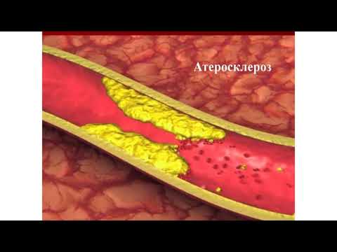 Видео: Школа здоровья по дислипидемии.  Занятие  1 "Что такое дислипидемия?"