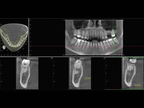 Видео: Замер толщины костей в OneVolumeViewer | OneVolumeViewer-де сүйек қалыңдығын өлшеу