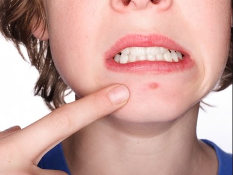 Видео: КАК ИЗБАВИТЬСЯ ОТ ПРЫЩЕЙ за 1-2 дня. Подростковые прыщи. Высыпания в критические дни.