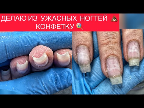 Видео: КОМБО🔥СКРУЧИВАЮЩИЕСЯ И  КРИВО РАСТУЩИЕ НОГТИ 😰РЕМОНТ НОГТЕЙ И ФРАНЦУЗСКИЙ МАНИКЮР😍