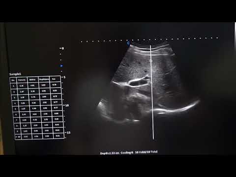 Видео: CHISON p-SWE эластометрия сдвиговой волной