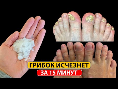 Видео: Лучшее средство от ГРИБКА НОГТЕЙ. Это копеечное средство уберет ГРИБОК НОГТЕЙ за 15 минут