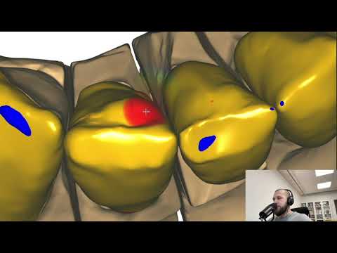 Видео: Exocad 3.1 rijeka modelling dental cad exocad video exocad Video Tutorial   Моделирование в exocad 2