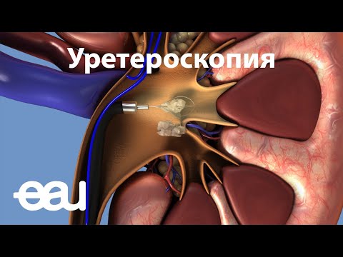 Видео: Уретероскопия (EAU - URS RU)