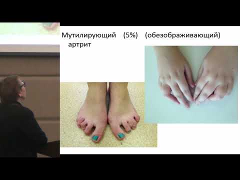 Видео: Чебышева С. Н., Жолобова Е.С. Псориатический артрит у детей. 20-летний опыт наблюдения