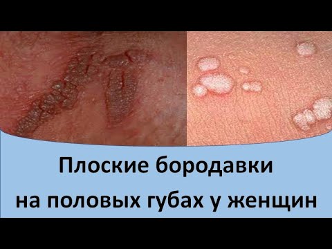 Видео: Плоские бородавки на половых губах у женщин