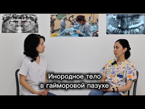 Видео: Перфорация гайморовой пазухи после удаления зуба. Инородное тело в гайморовой пазухе. Диагностика