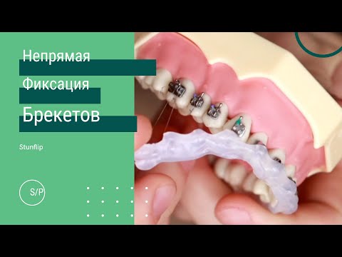 Видео: НЕПРЯМАЯ ФИКСАЦИЯ БРЕКЕТОВ