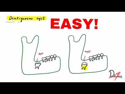 Видео: Одонтогенная киста — это просто!