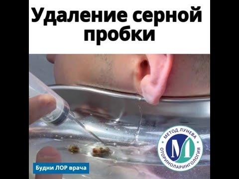 Видео: Удаление серной пробки из уха.