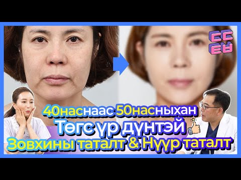 Видео: [Эмч зөвлөж байна] Дунд насныхны унжсан дээд доод зовхи, хацрын суултыг хэрхэн засах вэ?