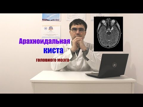Видео: Арахноидальная ликворная киста головного мозга: симптомы, лечение