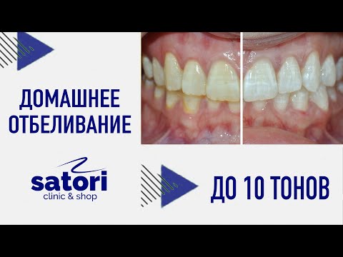 Видео: Домашнее отбеливание зубов Оpalescence, капы для отбеливания зубов
