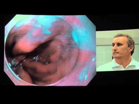 Видео: 21 СВ Кашин   APC абляция пищевода Барретта