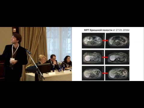 Видео: Лечение диссеминированного РМЖ у пациентки с BRCA мутацией на 2 триместре беременности