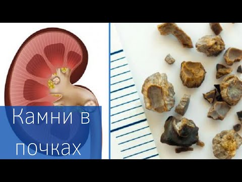Видео: КАМНИ В ПОЧКАХ | Как лечить? | Профилактика