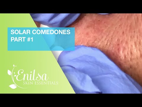 Видео: Солнечные комедоны