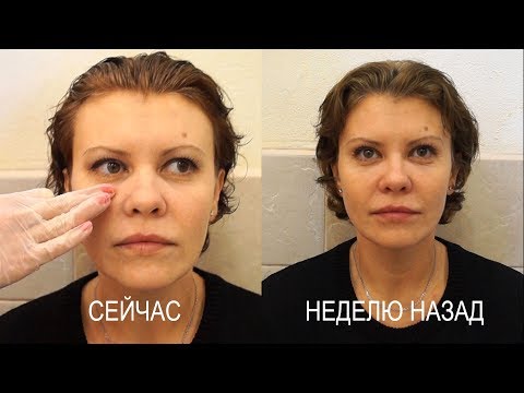 Видео: Оценка растворения филера гиалуронидазой и коррекция щечно-скуловой зоны. Светлана #2
