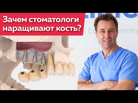 Видео: Синус-лифтинг при имплантации зубов / Как проводится синус-лифтинг?
