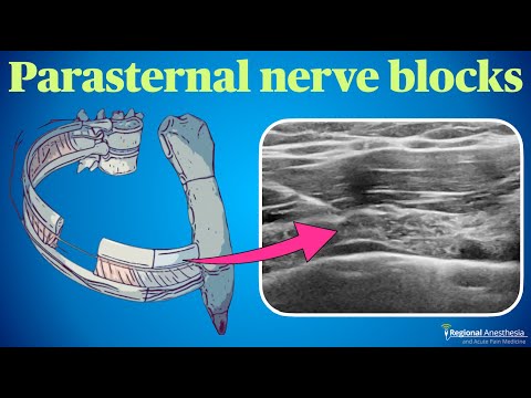 Видео: Блокады парастернального нерва
