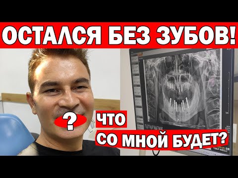 Видео: 😱ТРУДНО ЖИТЬ БЕЗ ЗУБОВ! Как я лечу ЗУБЫ В ТУРЦИИ и ставлю ИМПЛАНТЫ, КОРОНКИ - ЦЕНА/ Анталия