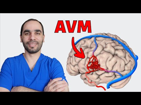 Видео: Артериовенозная мальформация АВМ: причины, обследование и лечение