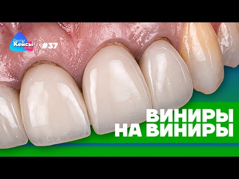 Видео: Виниры на виниры | Дентал Кейсы от BG #37